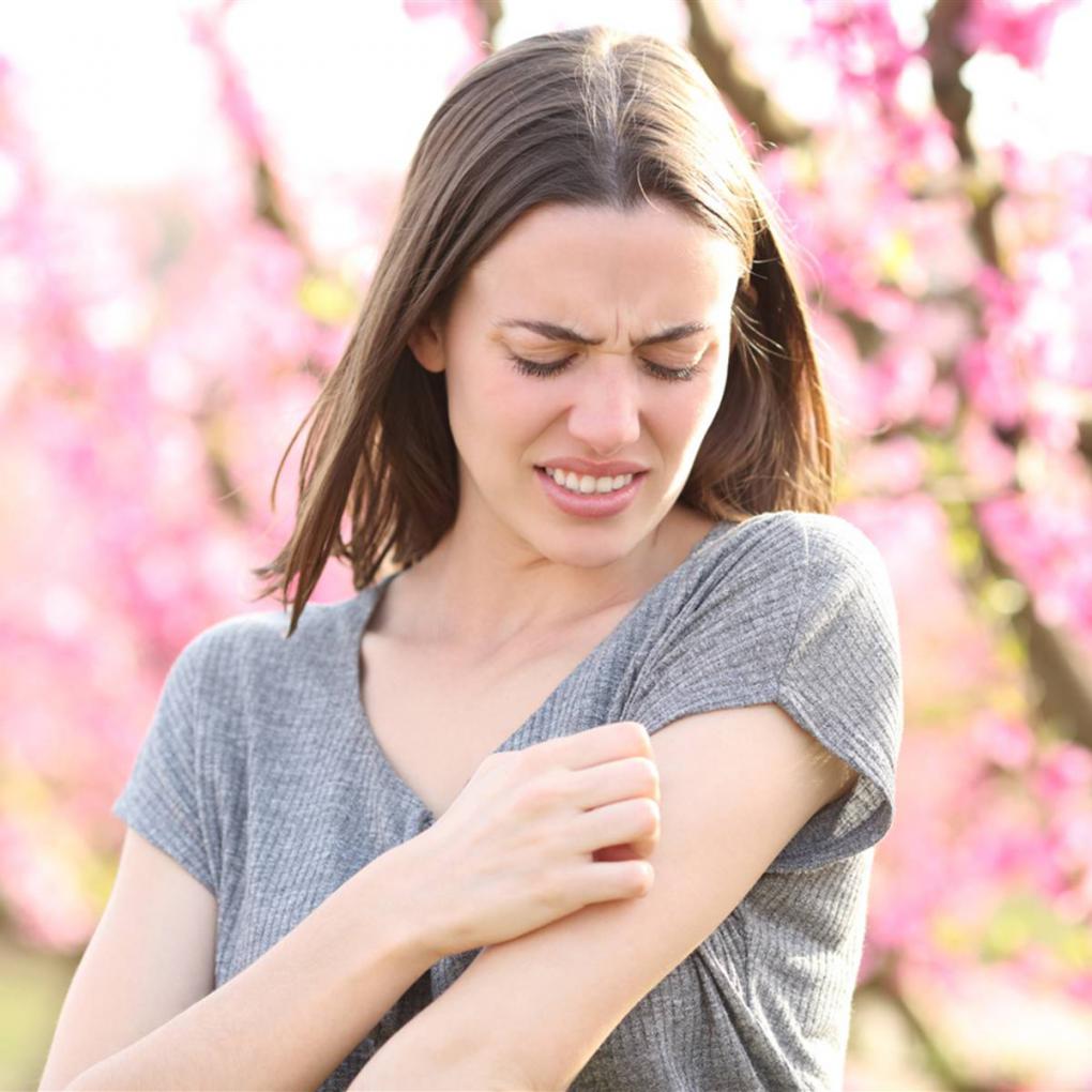 9 tratamientos naturales para las picaduras de mosquito